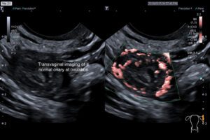 transvaginal-imaging