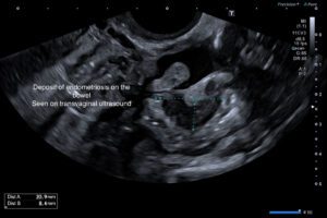 transvaginal-ultrasound-endometriosis
